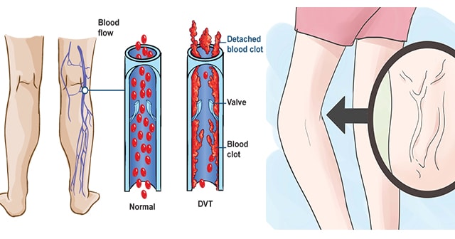 Here’s How To Lower The Risk Of Blood Clot That Could Lead To Stroke Before It Happen
